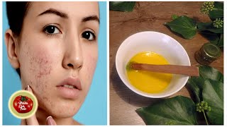 Remove these ugly acne FOREVER! 100% effective old nature medicine