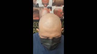 2 nd session of  SCALP MICROPIGMENTATION  / very natural looking