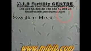 Swollen Head Sperm Movement video