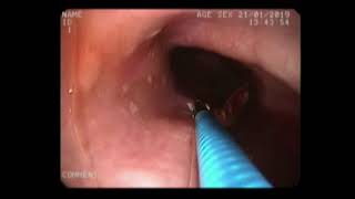 endoscopic removal of large fish bone from esophagus