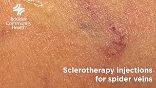 Sclerotherapy for spider veins | BCH Radiology