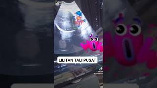 LILITAN Tali Pusat