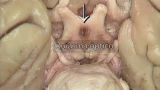 4 7 7 Mesencéfalo y  pedúnculos cerebrales