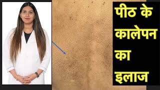 पीठ के कालेपन का कारण व इलाज । Back darkness removal | Dark Back Treatment । Maculer amyloidosis |