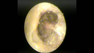 Endoscopic two handed T.B dissection-inside out mastoidectomy (dr.shreekantha acharya)