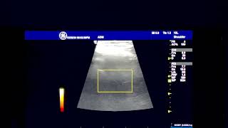 Nerves of the Anterior Hip triangle