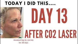 DAY 13- CO 2 LASER-  I can't believe what my FACE looks like TODAY. This is CRAZY!!!!!!!!!!!