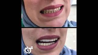 کامپوزیت ونیر در تهرانپارس | دندانپزشکی ترنج یا unique smile