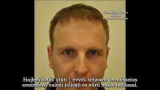 György hajbeültetés műtétje a Sikos Klinikán. Hair transplant result Sikos Clinic