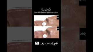 ڕێکاری _لووت_ بە _فیلەر#تجميل_ الانف_ بالفيلر#Using filler for nasal bridge correction