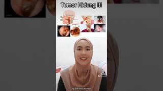 Tumor Hidung