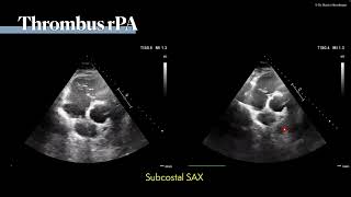 〖Echocardiography〗 Pulmonary embolism & the right ventricle 💘