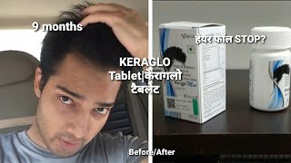 Receding Hairline Regrowth|KERAGLO tablet for हेयर फॉल |9 months use| Before after| Review| hindi