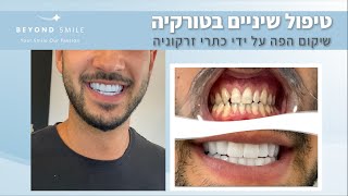 טיפול שיניים בטורקיה עם ביונד סמייל - שיקום בפה על ידי כתרי זרקוניה