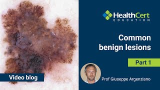 Common benign lesions Part 1 | Prof Giuseppe Argenziano