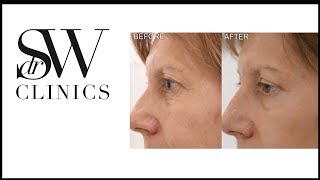 Dr SW Clinics - 'No knife' Blepharoplasty - Another satisfied patient | Dr Sherif Wakil