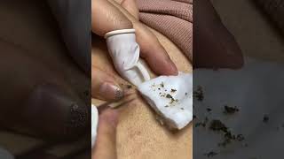 Blackhead Big