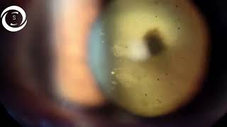 Ophthalmic Signs Anterior Segment