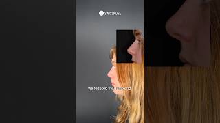 6 months after Closed Scarless Rhinoplasty | Dr. med. Simon Zimmermann