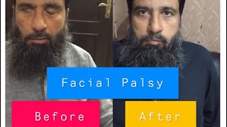 Facial Palsy