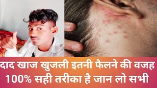 Fungal infection falna ki wajah | khujli itni jyada hone ki wajah | medicene help by ps