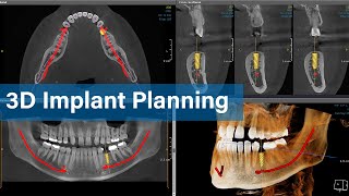 Digital Implant Planning - HDX WILL E-Learning Series 2nd Session