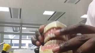 Prosthodontics- Festooning My Denture