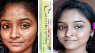 Aziderm 10% For Hormonal Acne|Aziderm 10%|Azelaic Acid||Aziderm Cream Review #acnetreatment