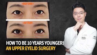 Everything about the upper eyelid surgery | Korea plastic surgery | K beauty