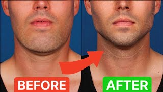 How To ACTUALLY Lose Face Fat in 5 EASY STEPS