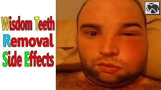 Wisdom Teeth Removal SIDE EFFECTS | Wisdom Teeth Removal