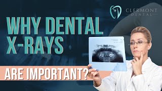 Why Dental X rays are important?