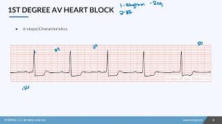 03.11 1st Degree AV Heart Block