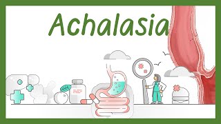 Achalasia (esophageal)  in children: Pathogenesis, symptoms and treatment | Achalasia animation