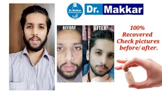 Tinea fully cured using homeopathic treatment by Dr Makkar  tinea facialis