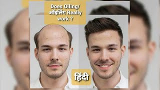 Oil for hair growth(बालों में तेल)||Receding hairline|Hairfall|Dandruff| Male Pattern Baldness|hindi