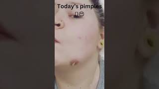 TODAYS PIMPLES !