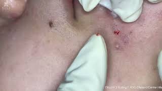 Big Cystic Acne Blackheads Extraction Blackheads & Milia, Whiteheads Removal Pimple Popping