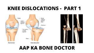 TRAUMATIC KNEE DISLOCATION - PART 1 - EPISODE 1