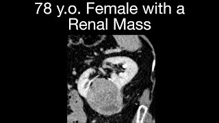 Renal Cell Carcinoma Case 3