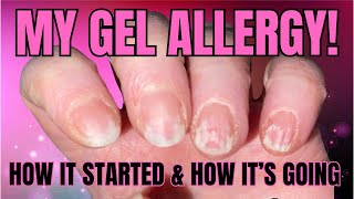 My Gel Nail Polish Allergy | How It's Going & A Quick Manicure