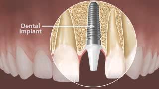 Treatments - Dental Implants