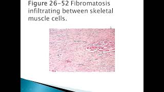 Fibromatoses Robbins & Cotran Pathologic Basis of Disease - 10th Edition