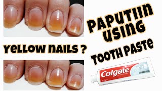 MADILAW NA KUKO? YELLOW stain on Nails | paano paputiin ang madilaw na kuko