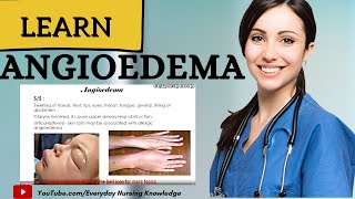 Learn About Angioedema I Everyday Nursing Knowledge