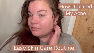 Easy Skin Care Routine  ( Stop Washing your face to clear acne)