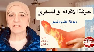 السكري وحرقة الساق والاقدام