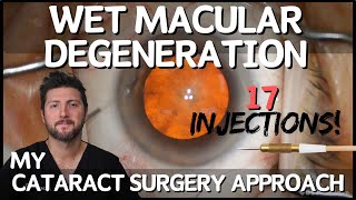 Cataract Surgery for Wet Macular Degeneration | Things to Consider