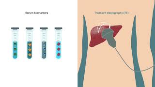 Improving diagnosis methods for liver fibrosis (Ann Lab Med)