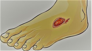 Piciorul diabetic: cauze si tratament modern cu celule mezenchimale #2